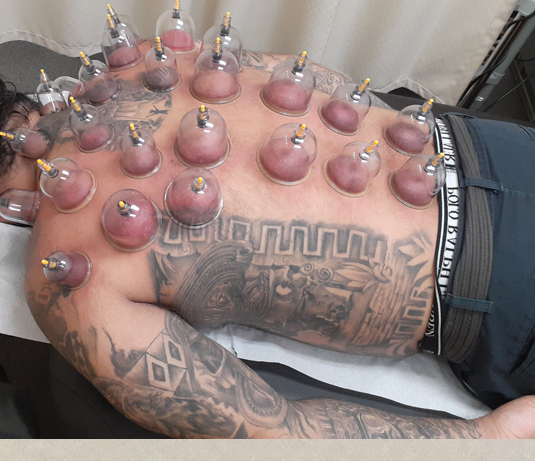 cupping on the back