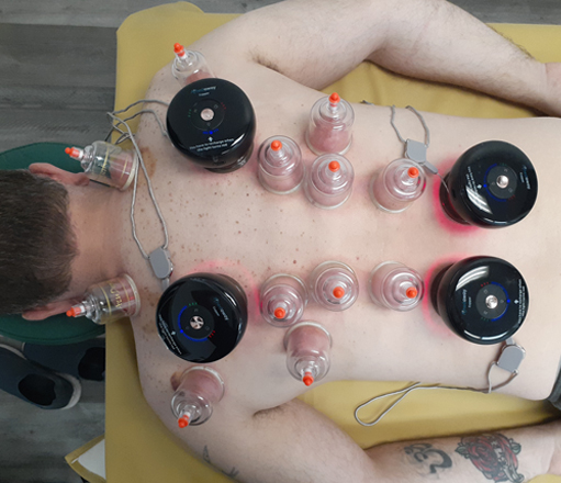 Infrared cupping machine