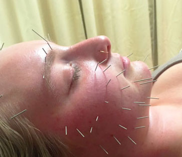 facial acupuncture